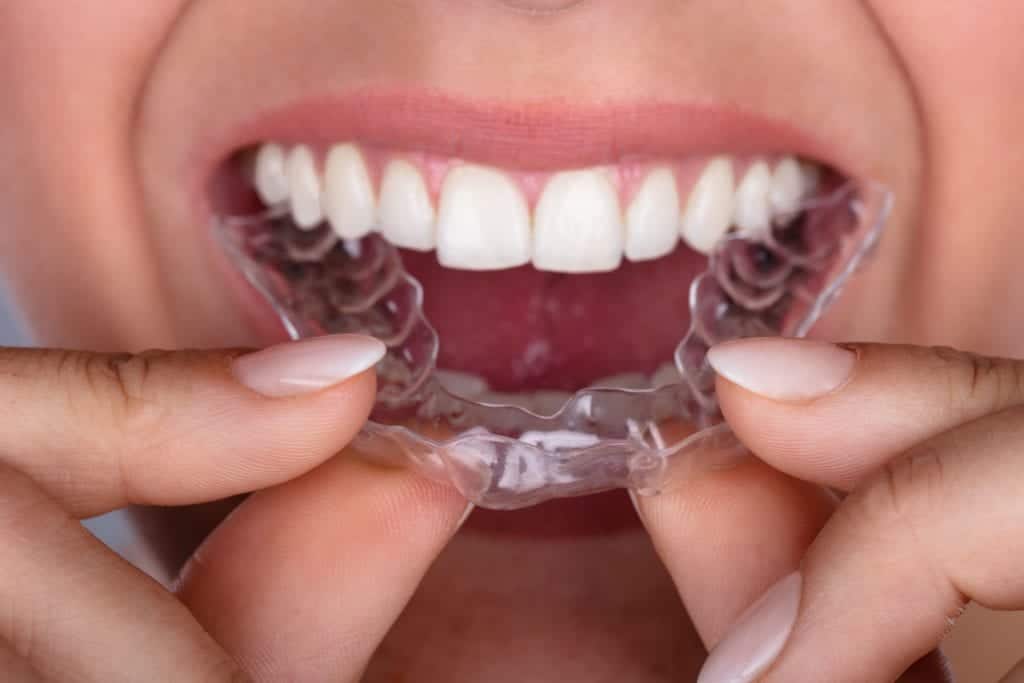 Woman placing an invisible aligner in her mouth