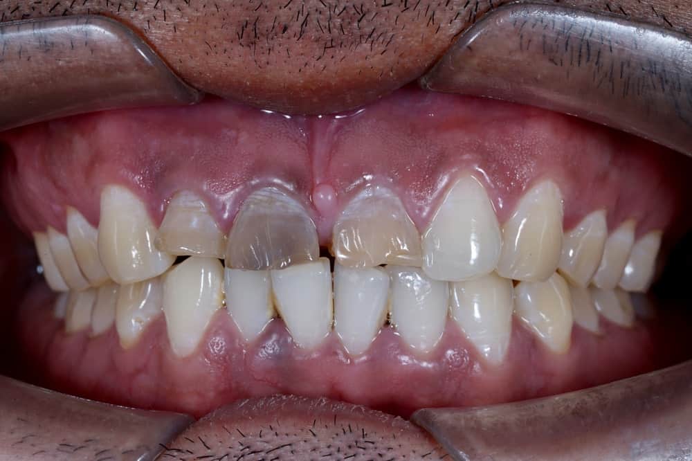 Man smiling with discolored front tooth