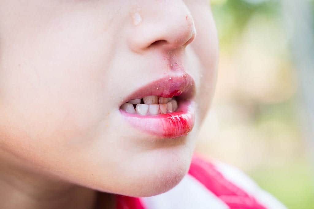 Young boy with bleeding lip