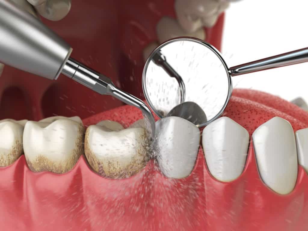 Digital rendering of a professional teeth cleaning