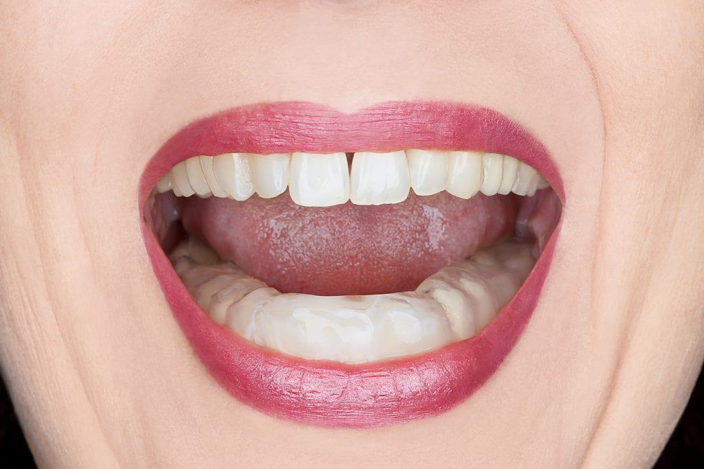 Woman wearing a mouth guard on her lower dental arch