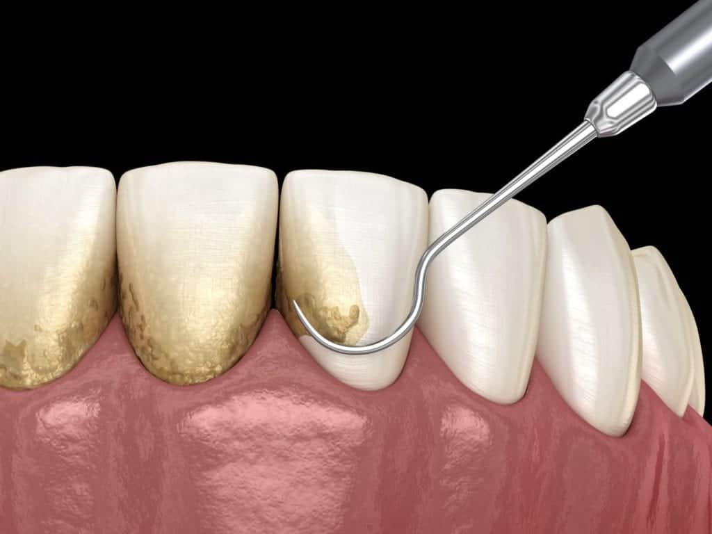 Dental tool removing plaque from tooth.