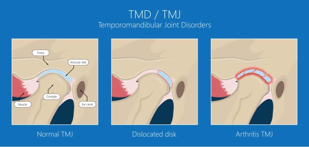 Graphic showing normal, dislocated and arthritis TMJ