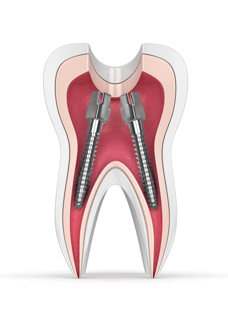 Tooth with a post and core foundation
