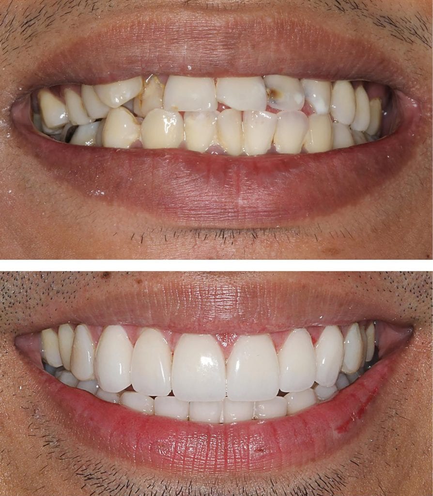 New smile with porcelain crowns and veneers