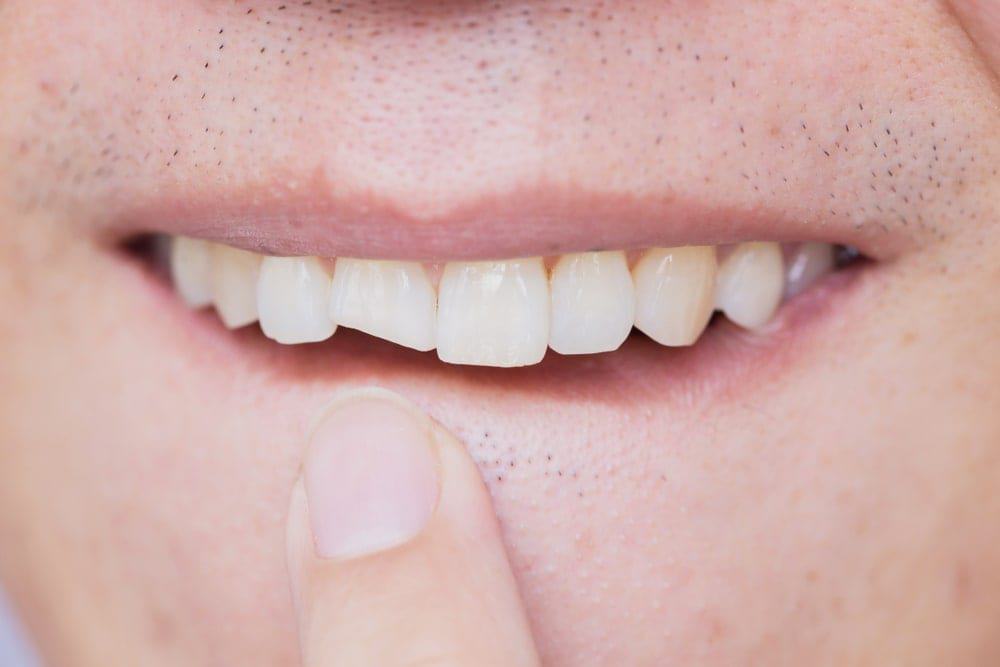Man pointing to broken front tooth